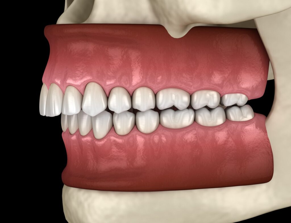 3D illustration of an overbite with the upper front teeth overlapping the lower teeth – deep bite vs overbite